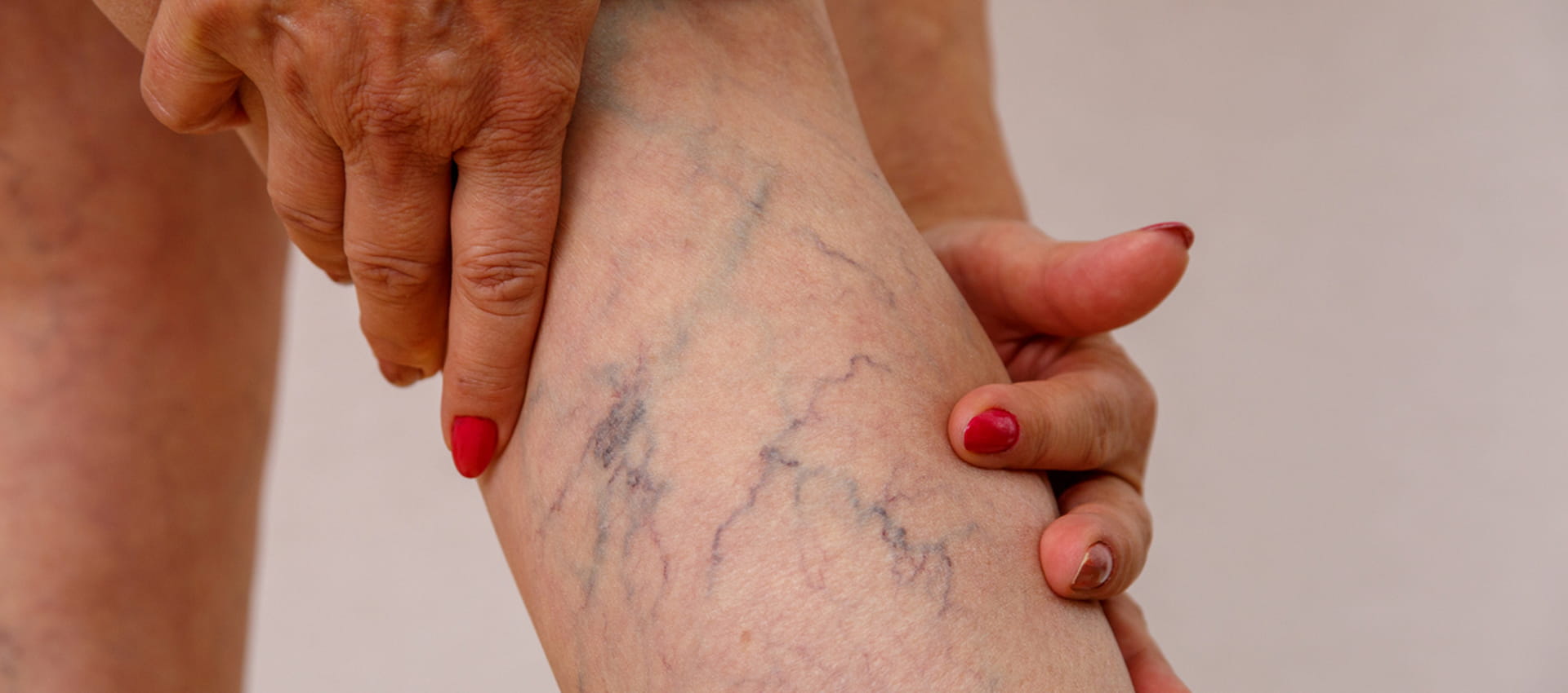 Say Goodbye to Varicose Veins with the Best Treatment in Miraj